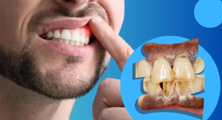 The Silent Threat Identifying Periodontal Disease Symptoms for Early Detection 1